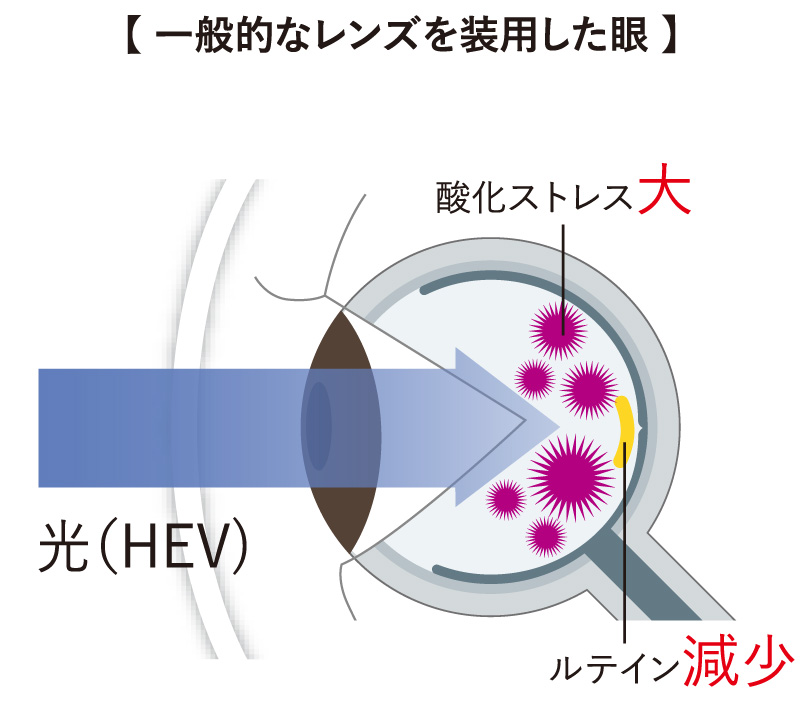 一般手的なレンズを装用した目