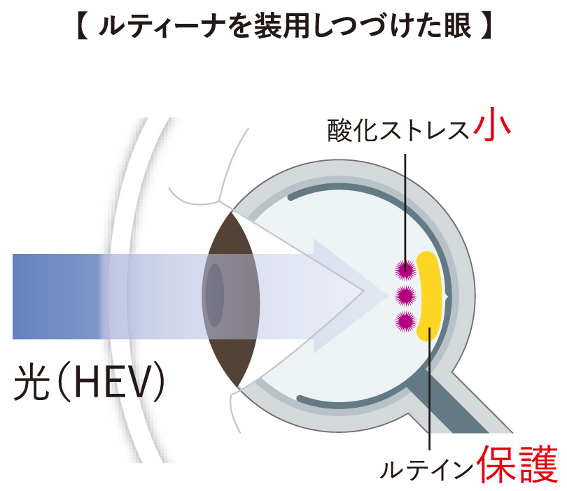 ルティーナを装用しつづけた眼